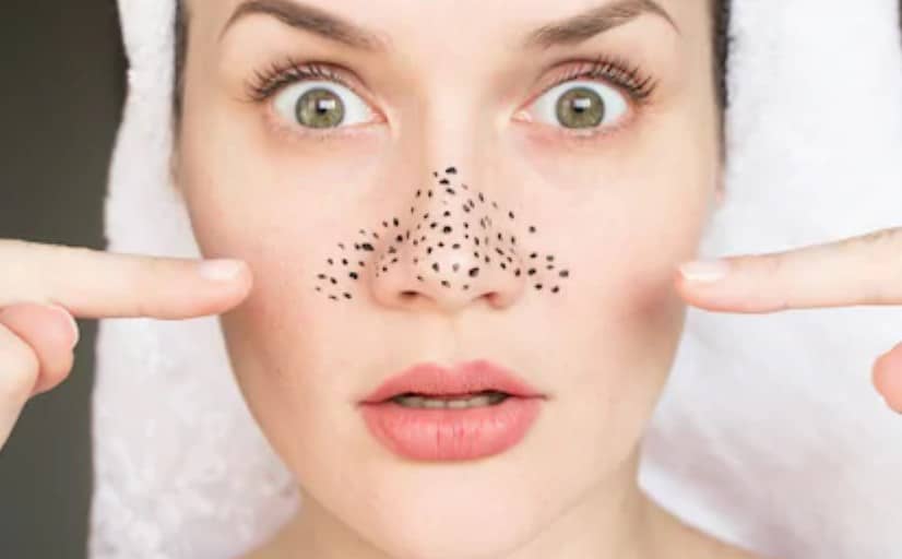 Best Home Remedies For Blackheads And Large Pores